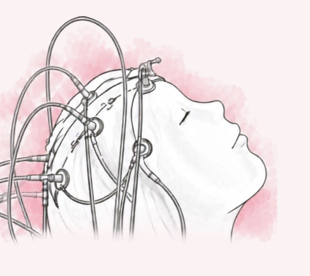 Epilepsiechirurgie und Neurostimulation verständlich erklärt